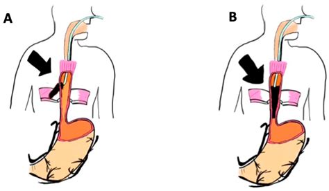 abdomac|Endoluminale Vakuum.